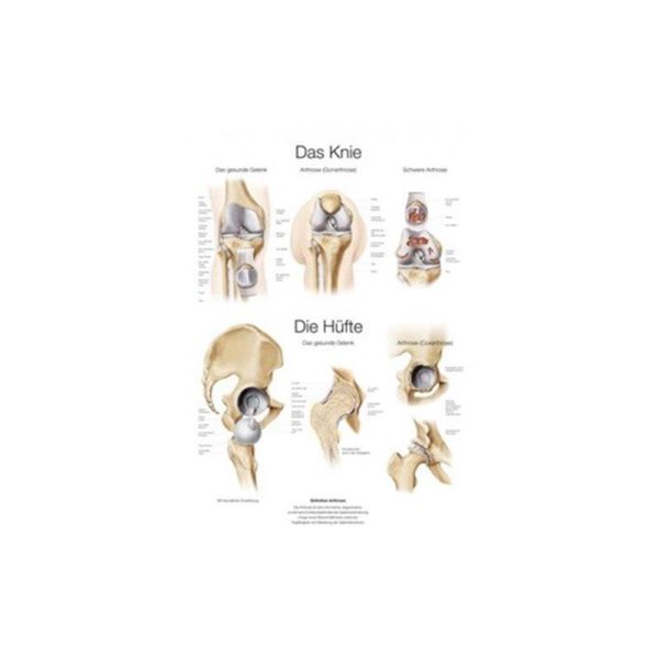 Poster - knee and hip